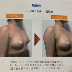 美乳ケア