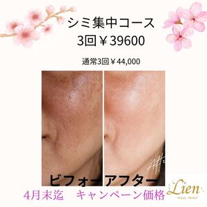 シミ集中ケアのビフォーアフター