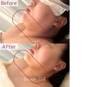 脂肪溶解 目の下、フェイスライン、二重あごにケア