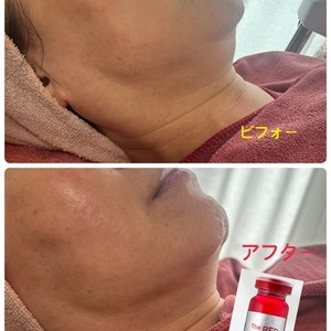 REDビフォーアフター